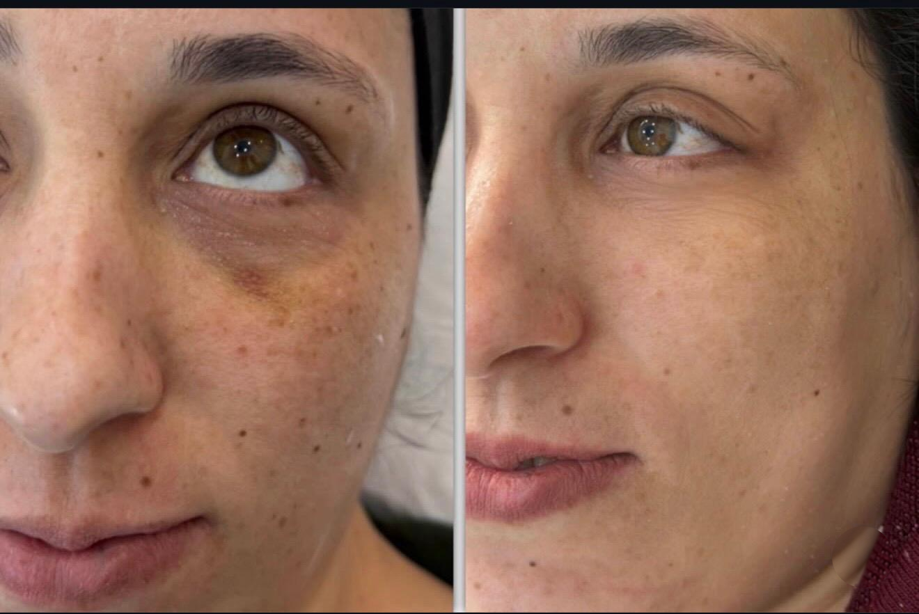 Clinic-supplied comparison photograph showing under-eye appearance, example 1