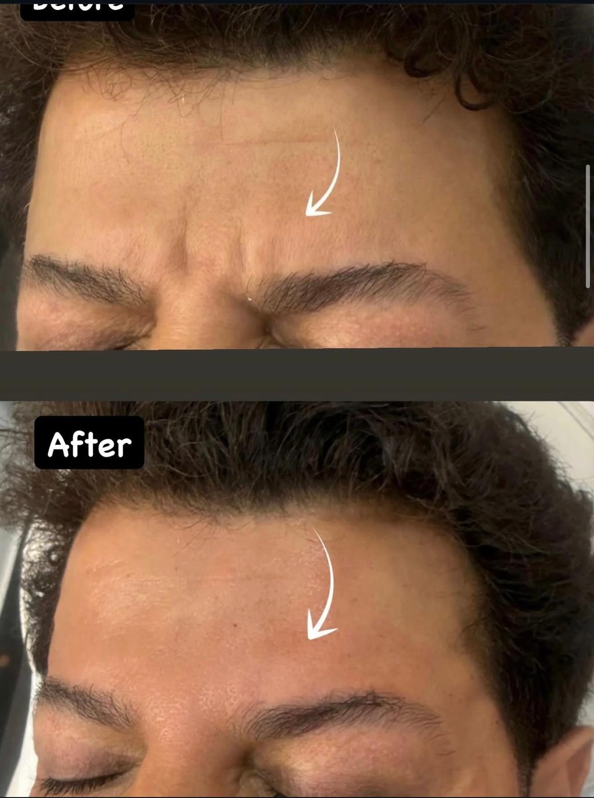 Clinic-supplied comparison photograph showing forehead appearance, example 2