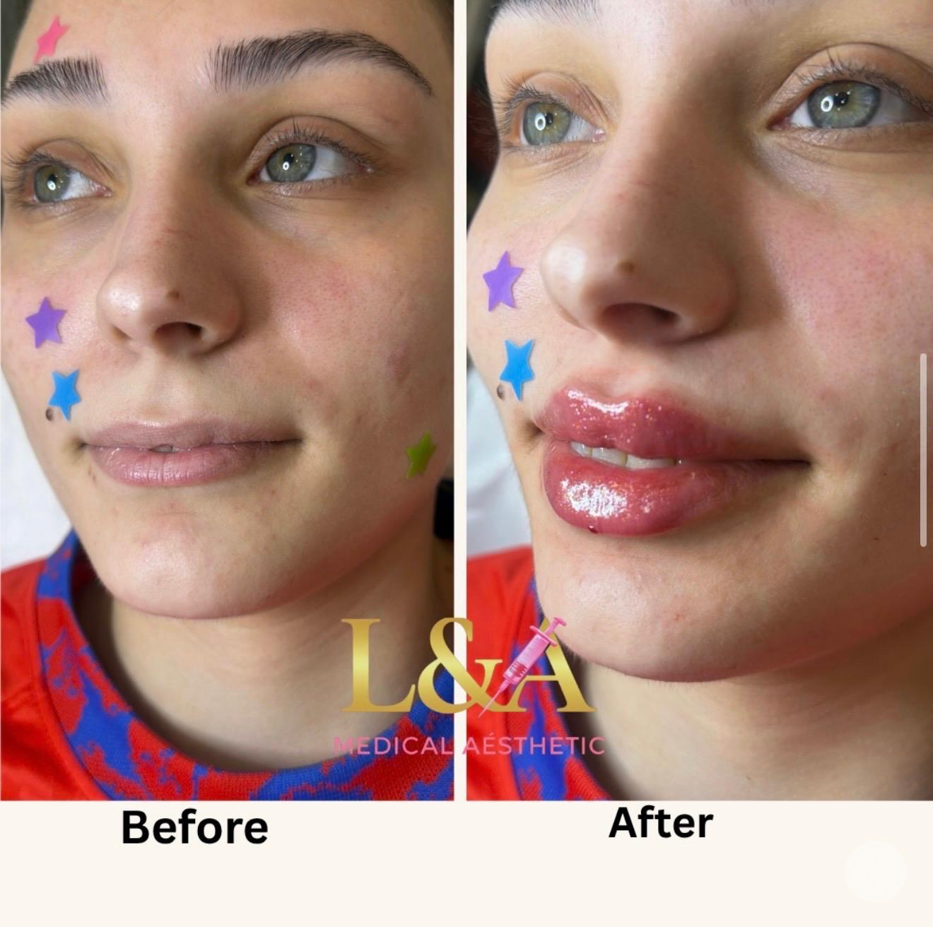 Clinic-supplied comparison photograph showing lip enhancement, example 3