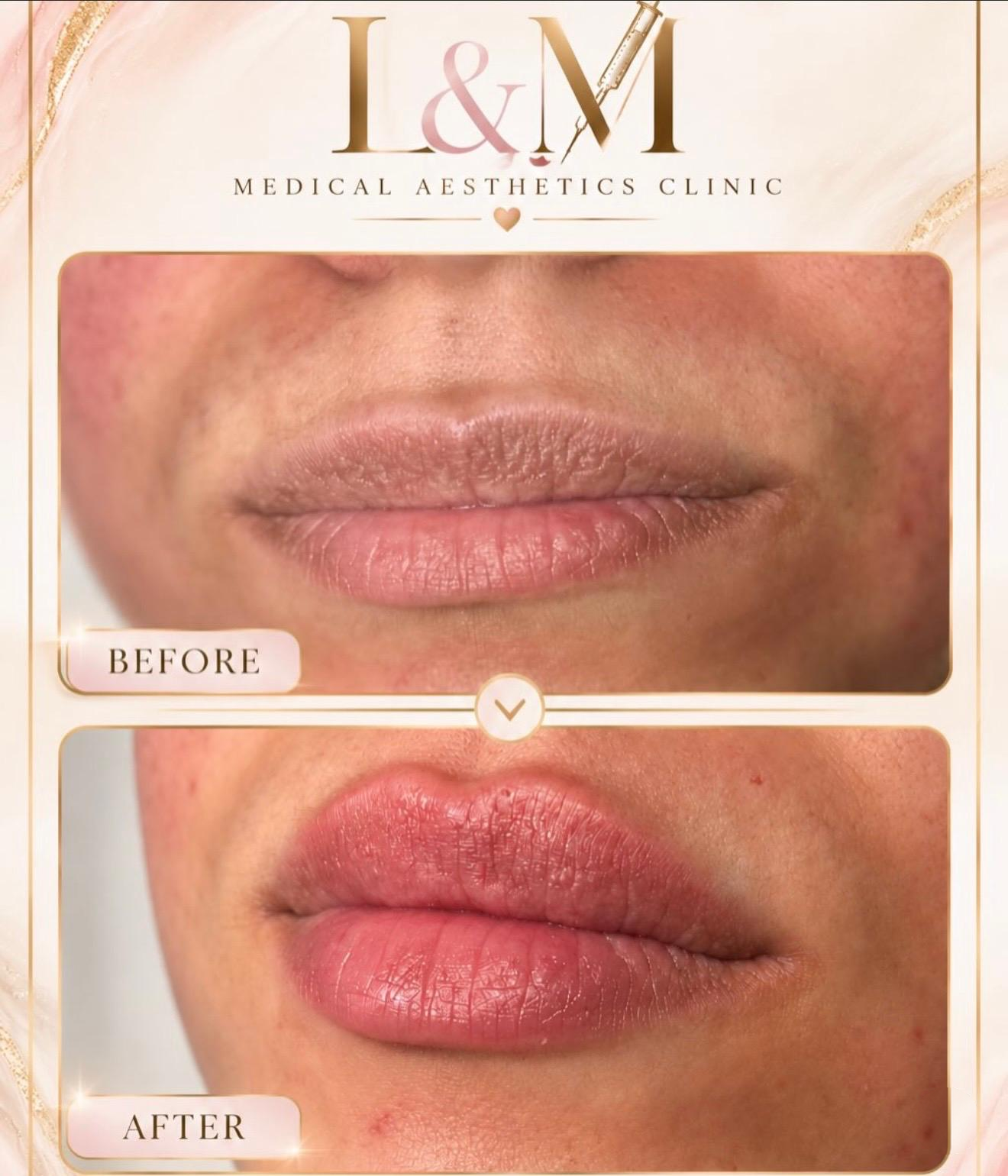 Clinic-supplied comparison photograph showing lip enhancement, example 5
